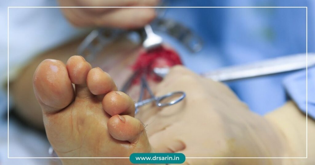 Bone healing after leg lengthening