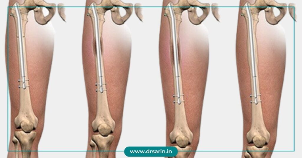Limb Lengthening Phases