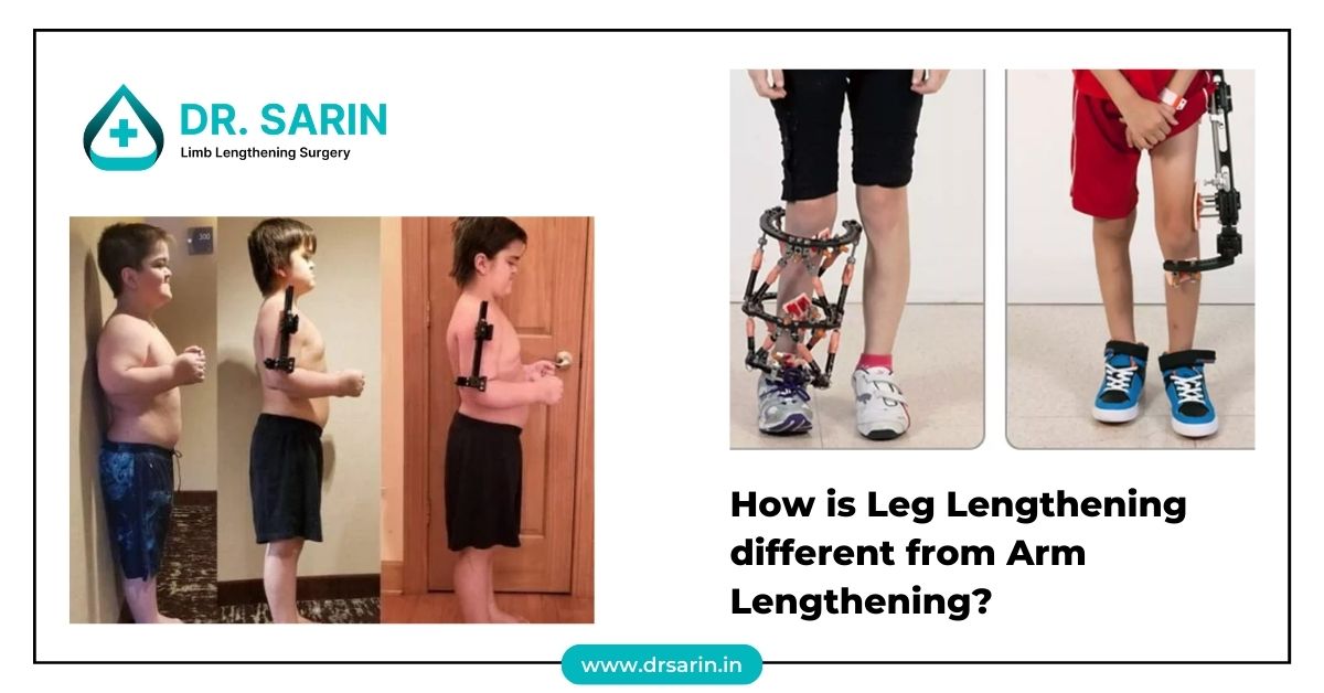 How is leg lengthening different from arm lengthening?