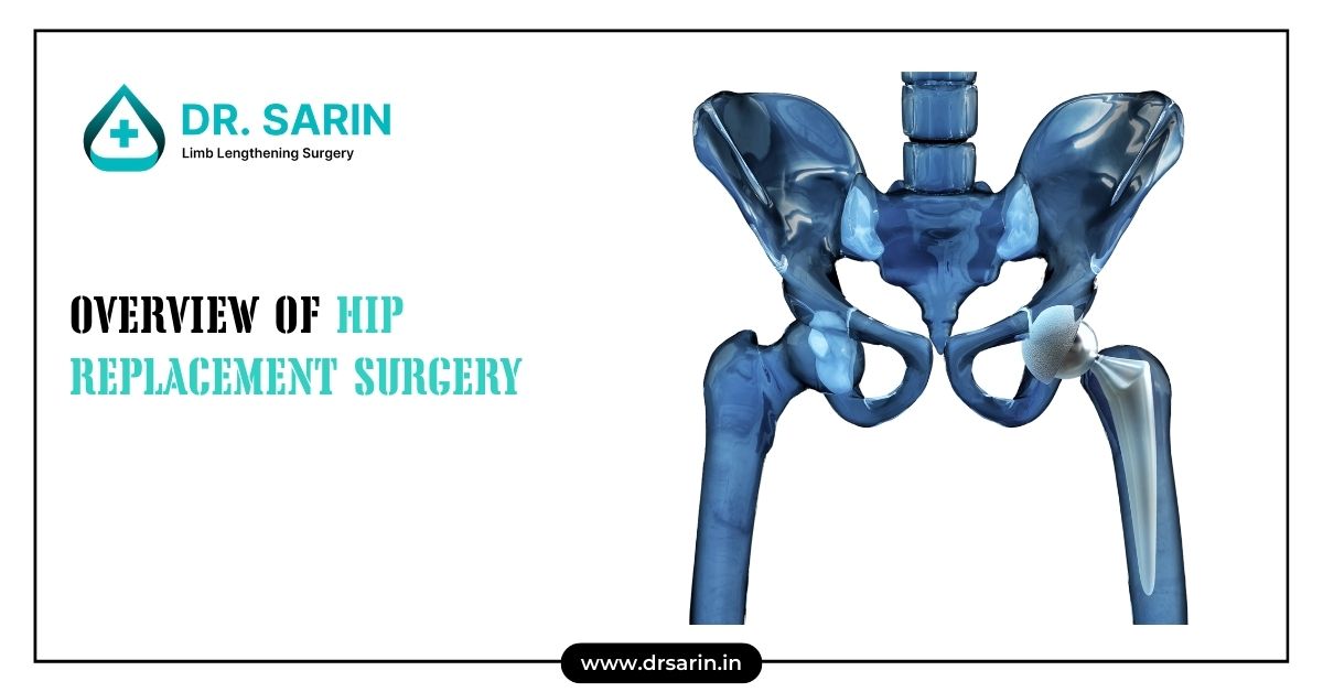 Hip Replacement Surgery - Dr. Sarin