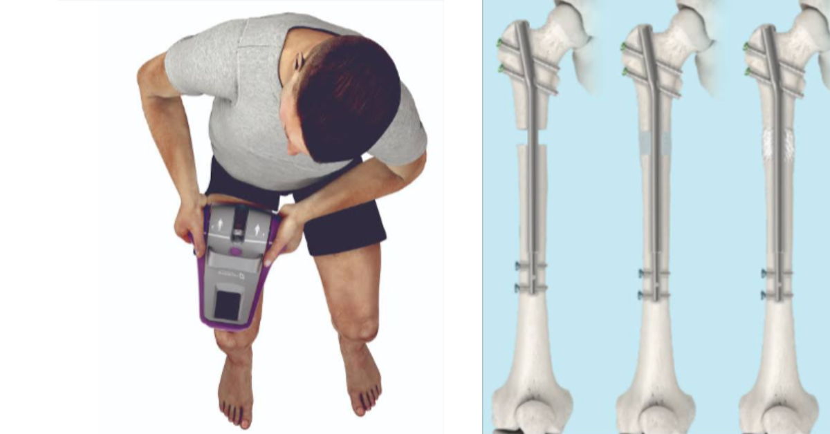 What is Precice Limb Lengthening?