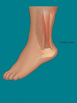 Achilles Tendon Tightness & Tendonitis
