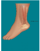 Achills tendon tightness & tendonitis