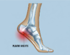 Plantar Fasciitis or Heel Pain