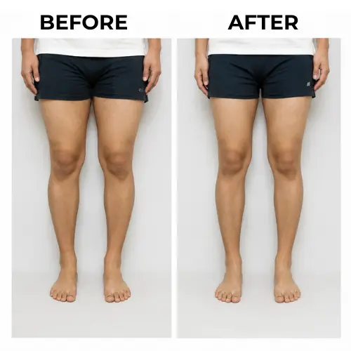 Bow Leg Correction