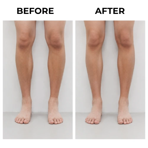 LLD Before & After Results