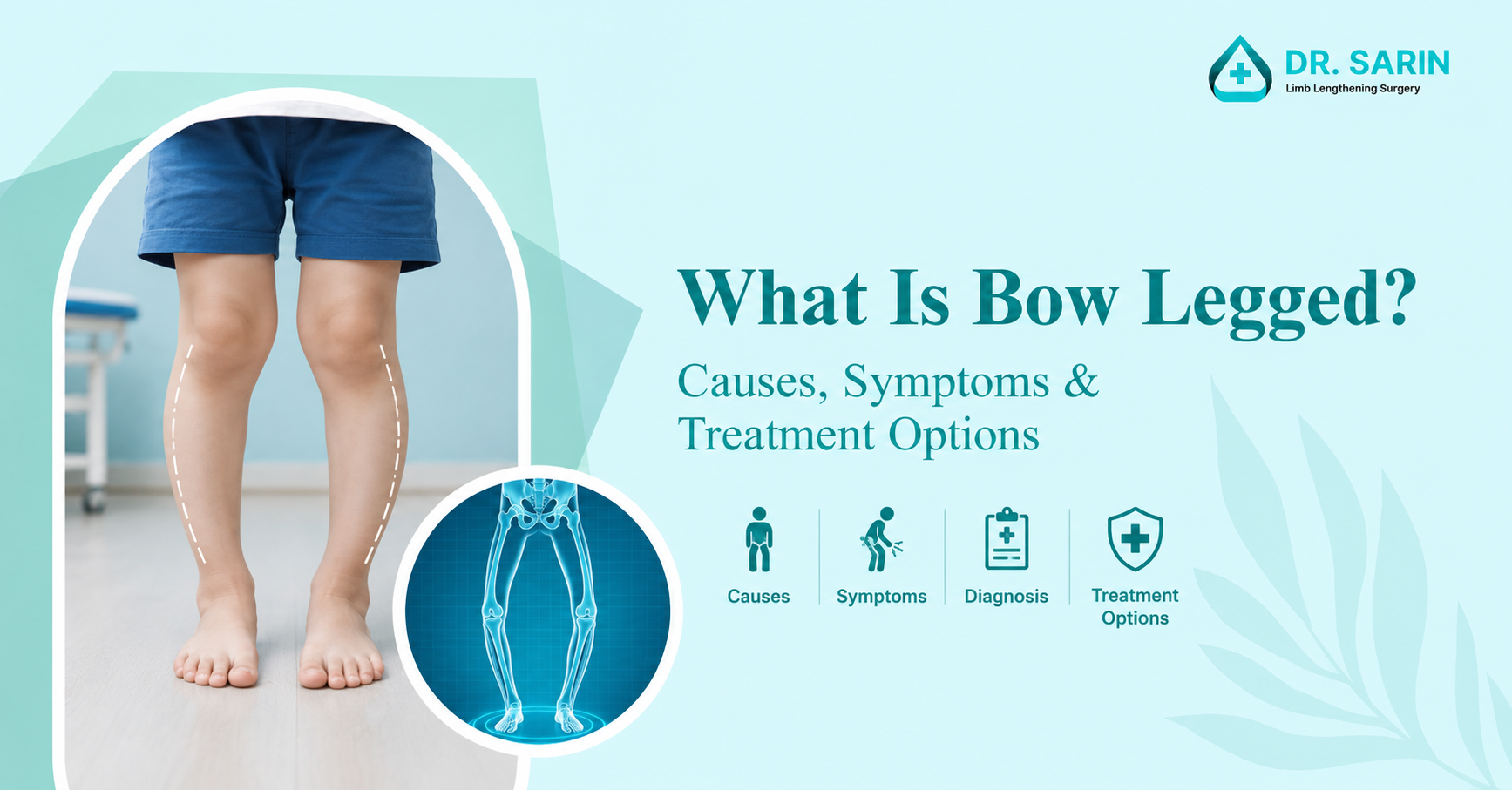 What is bow legged?