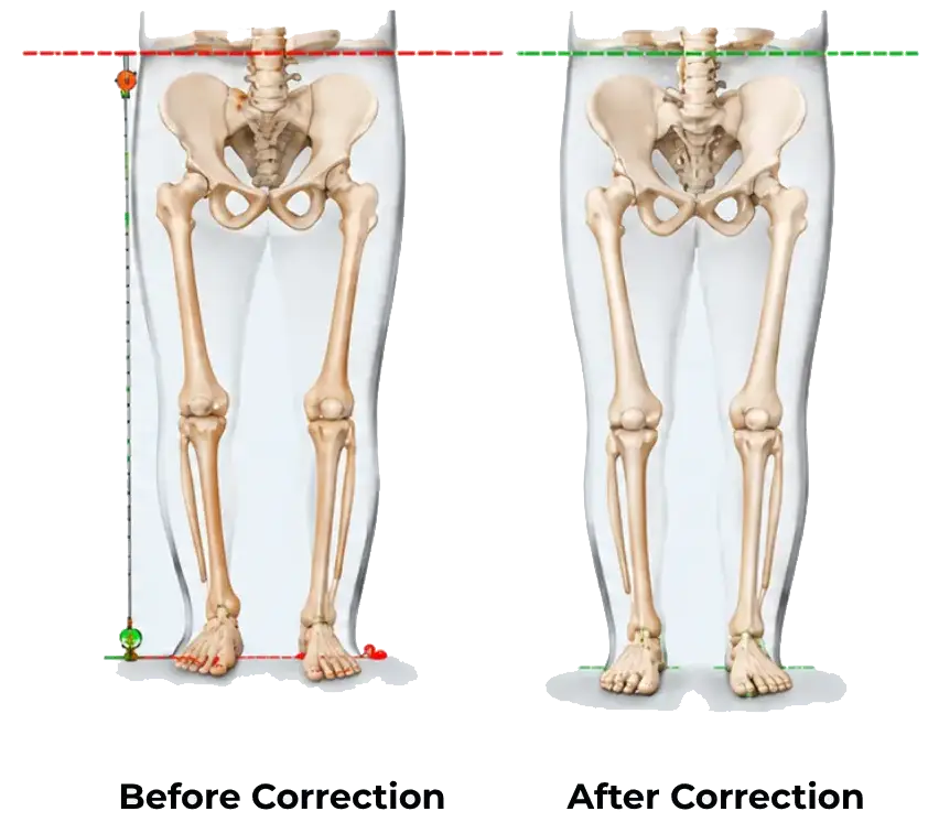 Limb Length Discrepancy (LLD)