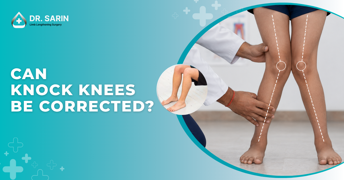 Can Knock Knees Be Corrected/