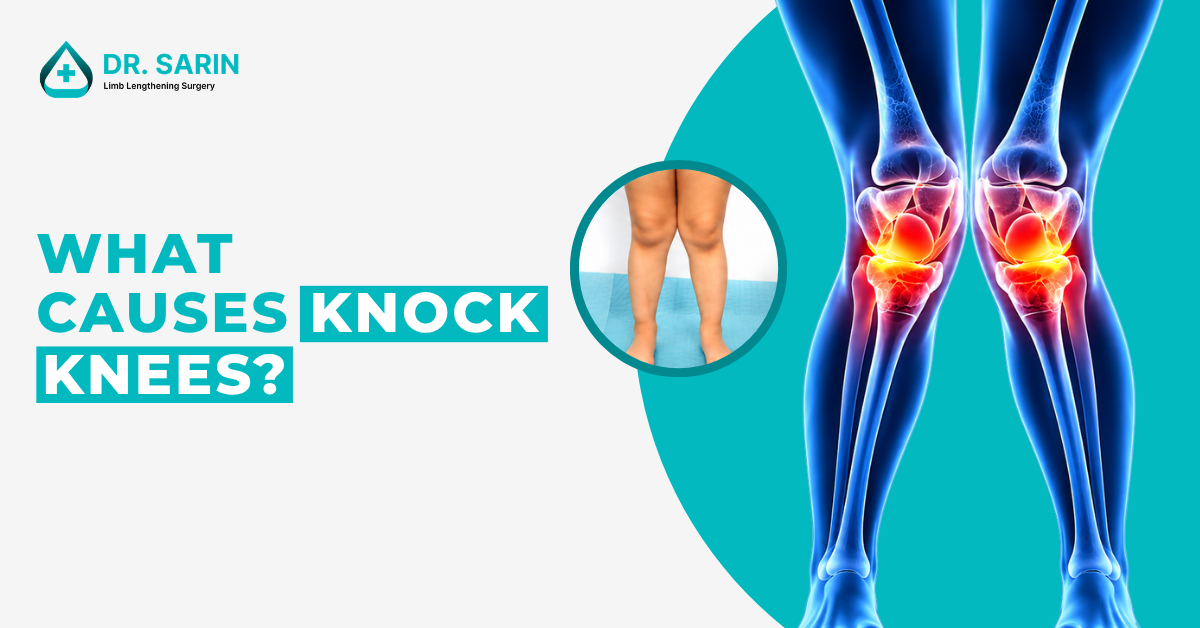 What Causes Knock Knees?