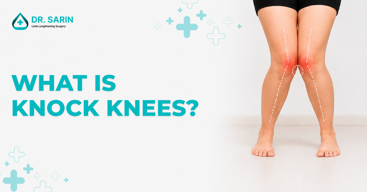 What is Knock Knees?