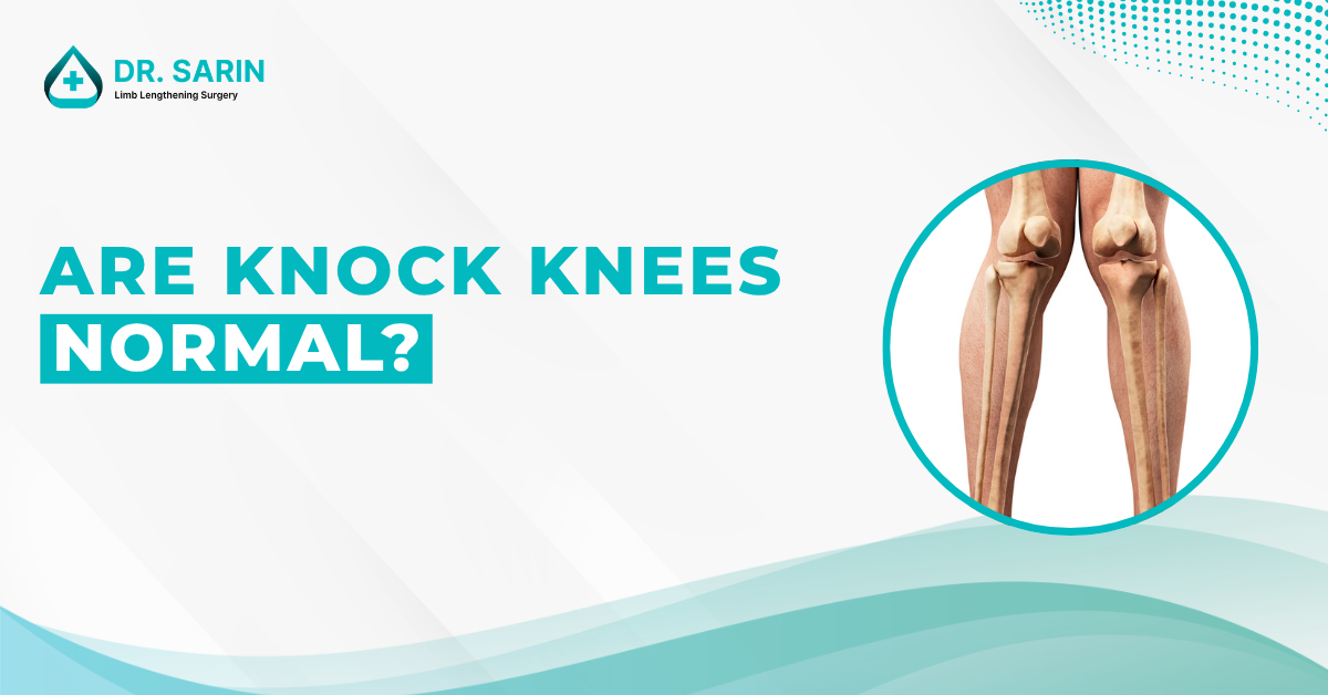 Are knock knees normal?