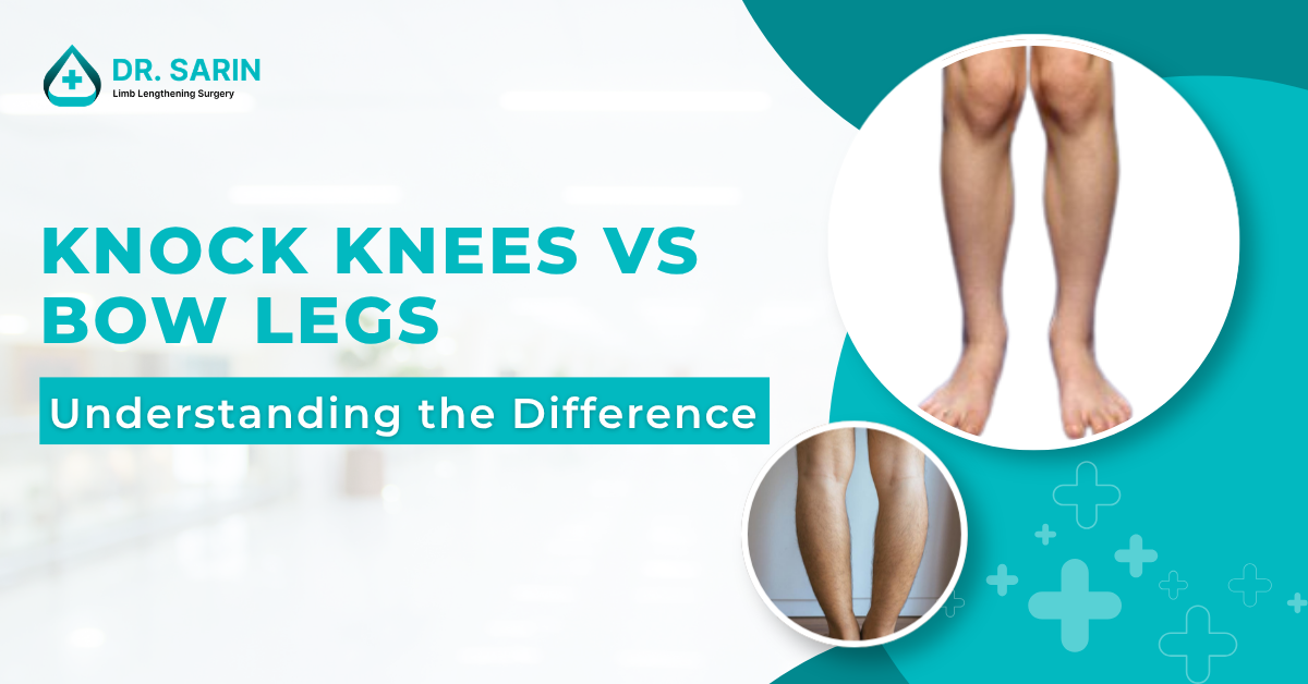 Knock Knees vs Bow Legs