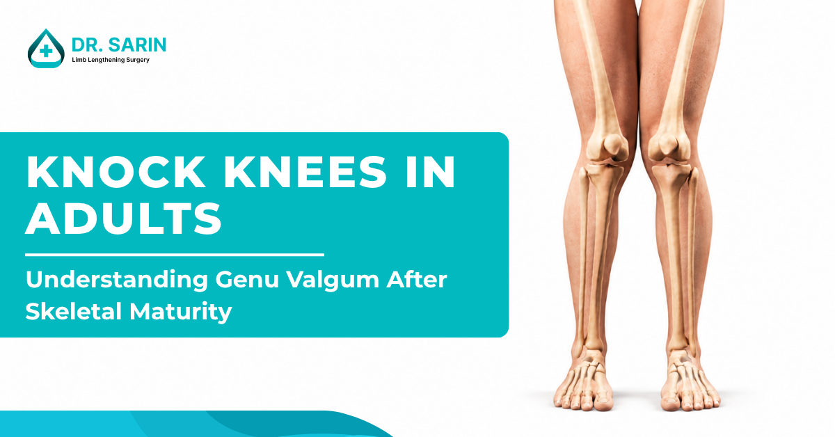 Knock knees in adults